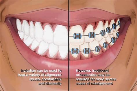 Invisalign Or Braces Zara Dental Houston