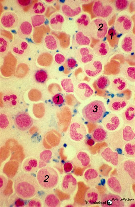 Iron Perls Staining Of Sideroblasts In Bone Marrow Smear Human