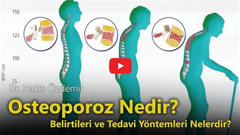 Osteoporoz Kemik Erimesi Nedir Belirtileri ve Tedavi Yöntemleri