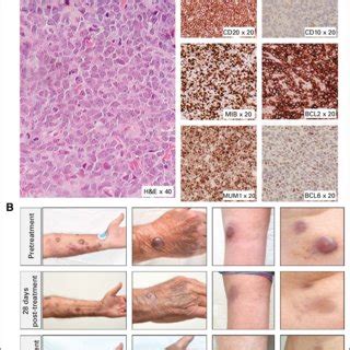 A Histology And Immunohistochemistry From Tumor Biopsy Showing A