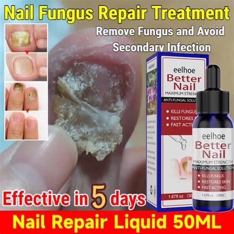 Effective In Daysoriginal Ml Eelhoe Nail Fungal Solution Foot