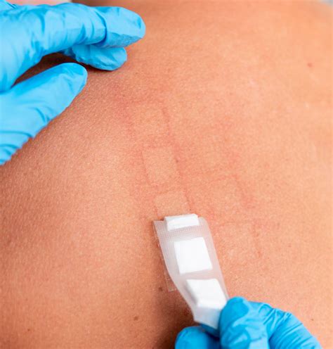 Pruebas De Alergias Test De Parche Vitadermic Dermatología