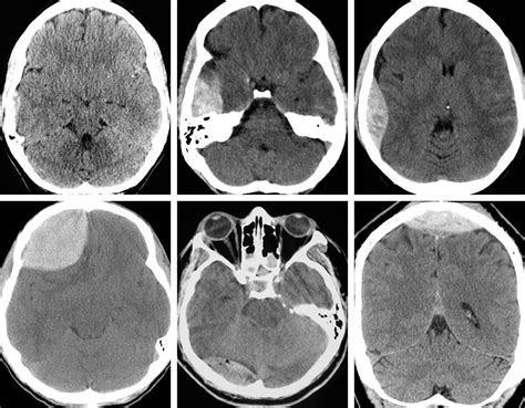 Epidural Hematoma The Neurosurgical Atlas By Aaron Cohen Gadol Md