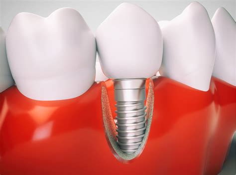 How Do Dental Implants Stay In Place Findglob