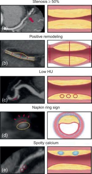 Atherosclerotic Plaque Radiology Key