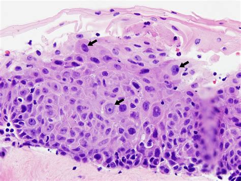 Squamous Cell Carcinoma In Situ Histology