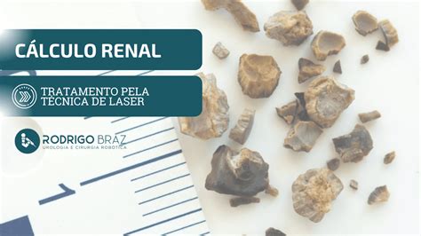 C Lculo Renal Tratamento Pela T Cnica De Laser Dr Rodrigo Braz De