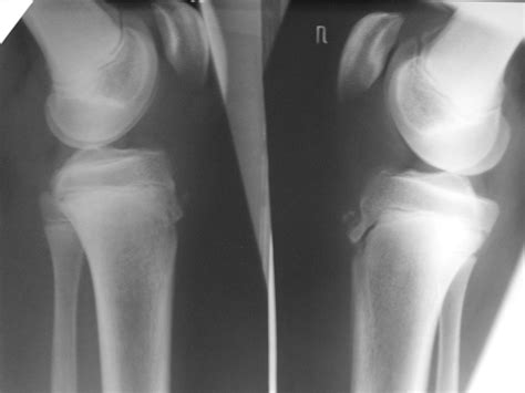 Болезнь Шляттера Фото — Картинки фотографии