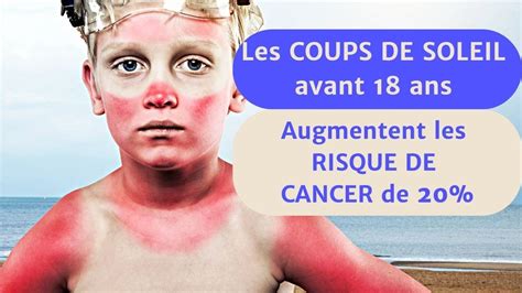 Cancer Les Coups De Soleil Augmenteraient Le Risque De Cancer Youtube