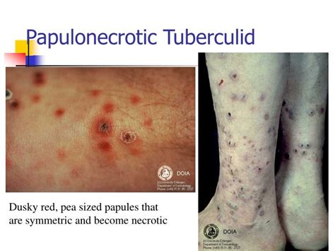 Ppt Mycobacteria Tuberculosis And Leprosy Powerpoint Presentation