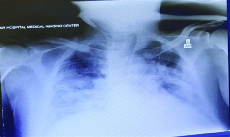 Patient S Chest X Ray When Admitted To The Icu Fig Patient S Chest