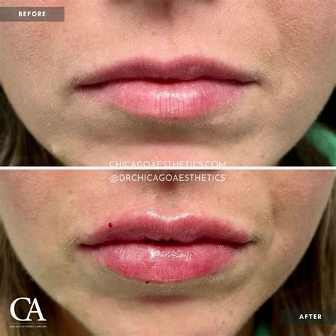 Lip Injections Before After Chicago Aesthetics Medspa