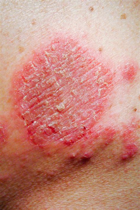 The 6 Most Common Types Of Eczema — And How To Treat Them Kinds Of