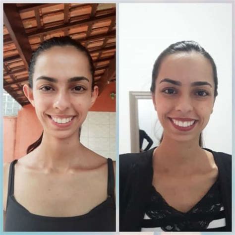 Otoplastia Antes E Depois Resultados Impressionantes