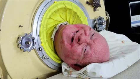 Paul Alexander Polio Survivor Who Spent Over 70 Years In Iron Lung