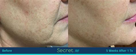 Secret Rf Micro Needling Genuineu Md