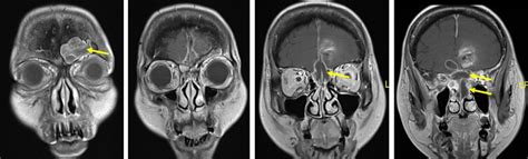 Acute Invasive Fungal Sinusitis Radiology Cases