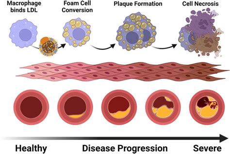 Atherosclerosis begins with the recognition of low-density lipoprotein ...