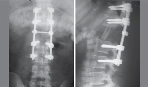 Scielo Brasil Melanotic Schwannoma Of The Lumbar Spine A Case