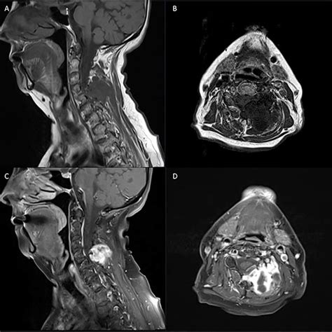 Pre Operative T1 And T2 Weighted Mri Left Sided Extra Axial Mass At Download Scientific