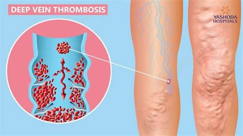 The Dreaded Deep Venous Thrombosis Or Dvt