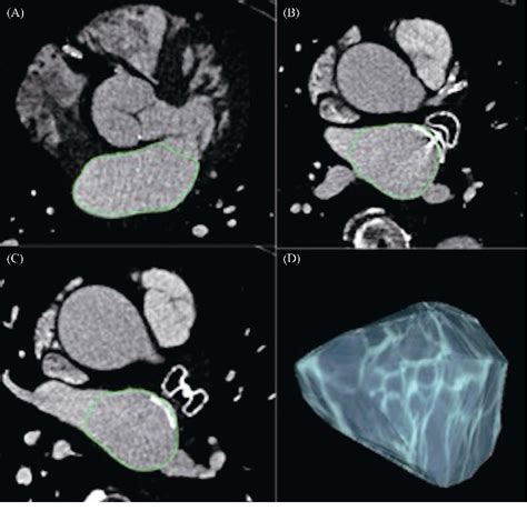 Figure 1 From Evaluation Of Left Atrial Remodelling Following