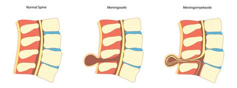 What Exactly Is Spina Bifida