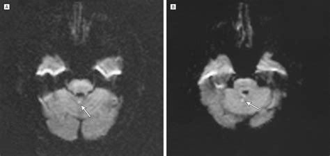 Isolated Gait Ataxia Due To Cerebellar Vermis Infarct Movement