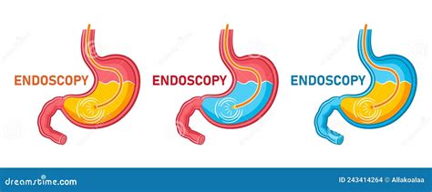 Esophagus Ulcer Affected Ulcer Of Esophagus Stomach Ulcer Affected