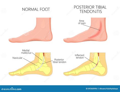 Medial Ankle Injuryposterior Tibial Tendonitis Stock Vector