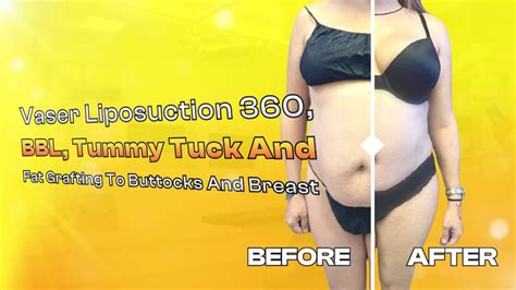 High Volume 360 Vaser Liposuction Before And After Tummy Tuck Procedure Fat Grafting Breast