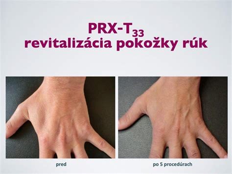 Biorevitalization Peeling PRX T33 Bratislava Vitality