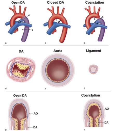 Videoaula sobre Persistência do canal arterial da anatomia à