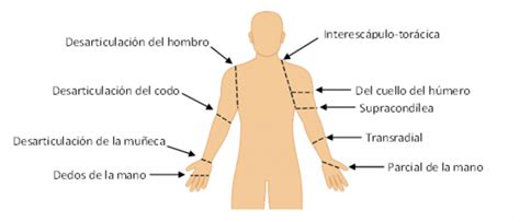 Tipos Y Causas De Amputaci N Romp