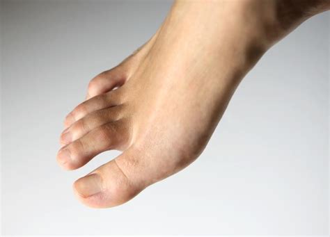 Causes And Symptoms Of Foot Corns