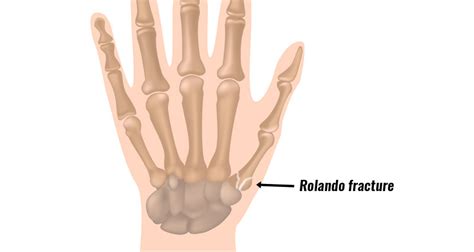 Broken Thumb (Fracture) - Symptoms, Types, Causes and Treatment