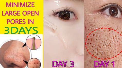 How To Get Rid Of Open Pores Blackhead And Whitehead With Natural Home