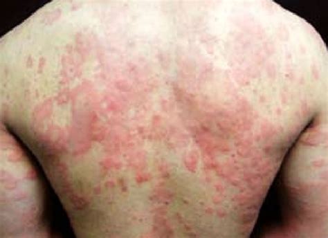 Imágenes Sobre La Urticaria