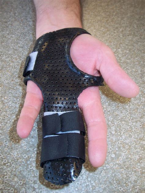 Radial Gutter Hand Splints