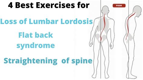 4 Best Exercises For Loss Of Lumbar Lordosis Youtube