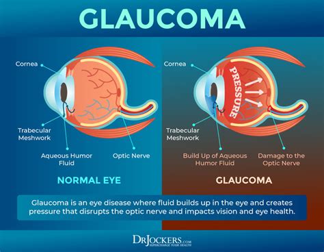 Glaucoma: Symptoms, Causes and Natural Support Strategies