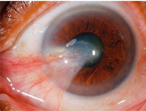 Pterygium Surfers Eye Causes And Risks Factors Explained Eyeonce