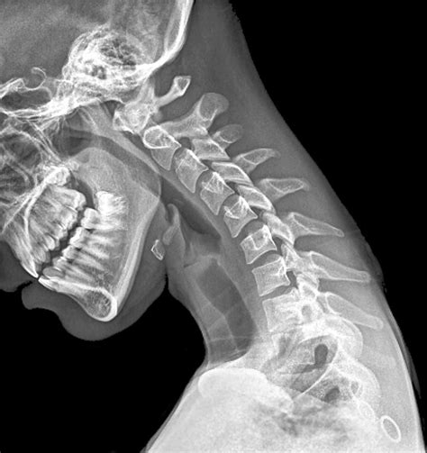 Pinched Nerves Causes Diagnosis And Treatment