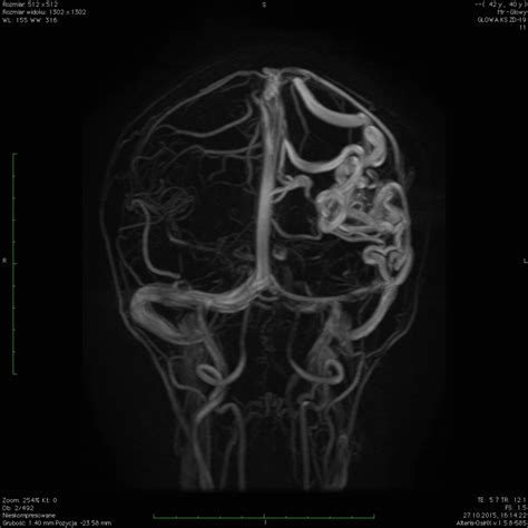 Badanie 13 Malformacja tętniczo żylna Zagrodzka edu pl