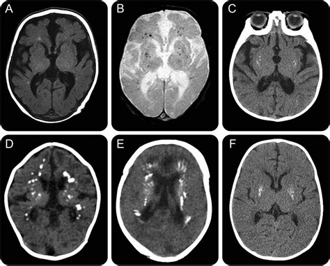 AICARDI-GOUTIERES SYNDROME PDF