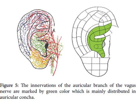 Transcutaneous Auricular Vagus Nerve Stimulation On Neurological