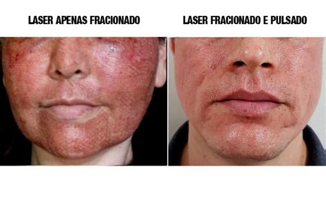 Laser De CO2 Antes E Depois Veja Como Fica A Pele No Pós procedimento