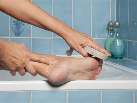 How to remove calluses: 8 Thing You Must Do To Get Rid Of Callus