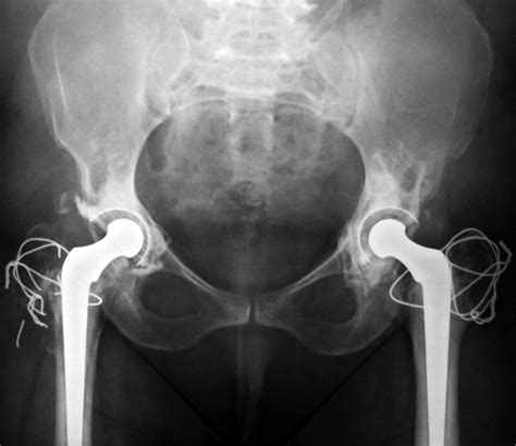 Acetabular Reconstruction In Patients With Low And High Dislocation Bone And Joint