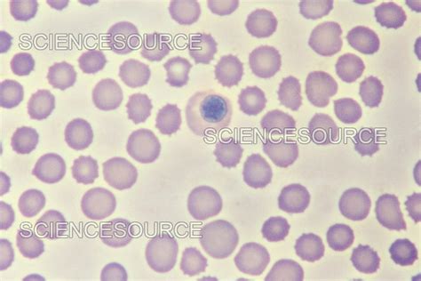 Erythroblastosis Fetalis Stock Image Science Source Images